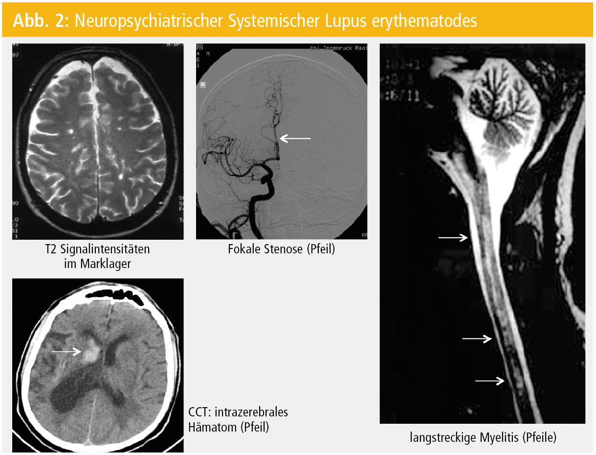 Neurologische Symptome im Rahmen internistischimmunologischer